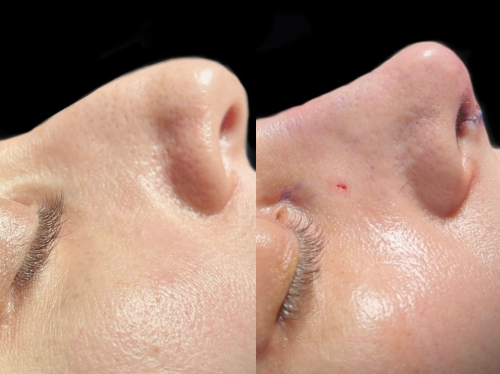 Side-by-side close-up images of a person's nose before (left) and after (right) rhinoplasty.