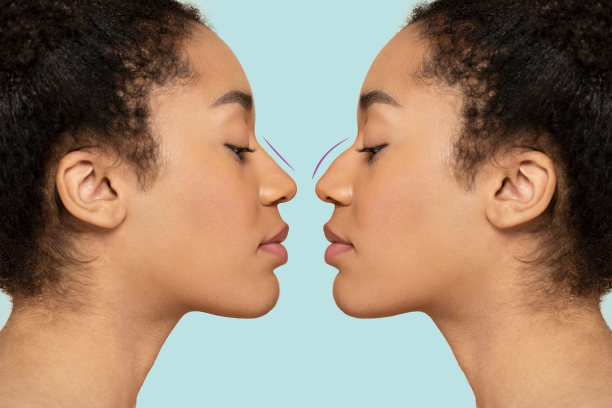 Plastic Surgery Tampa Rhinoplasty: Top Surgeons & Prices