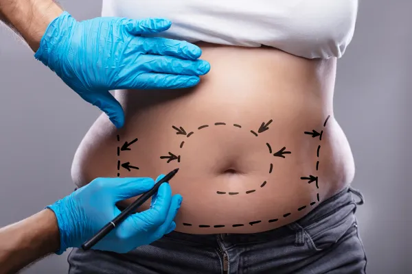 Planning Your Lipo 360? Here’s When to Book for Optimal Healing and Results