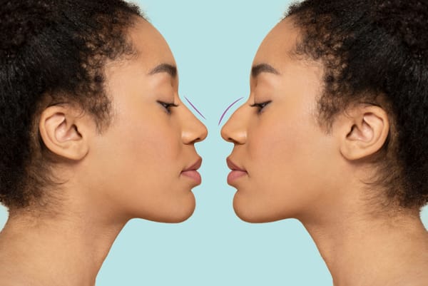Plastic Surgery Tampa Rhinoplasty: Top Surgeons & Prices